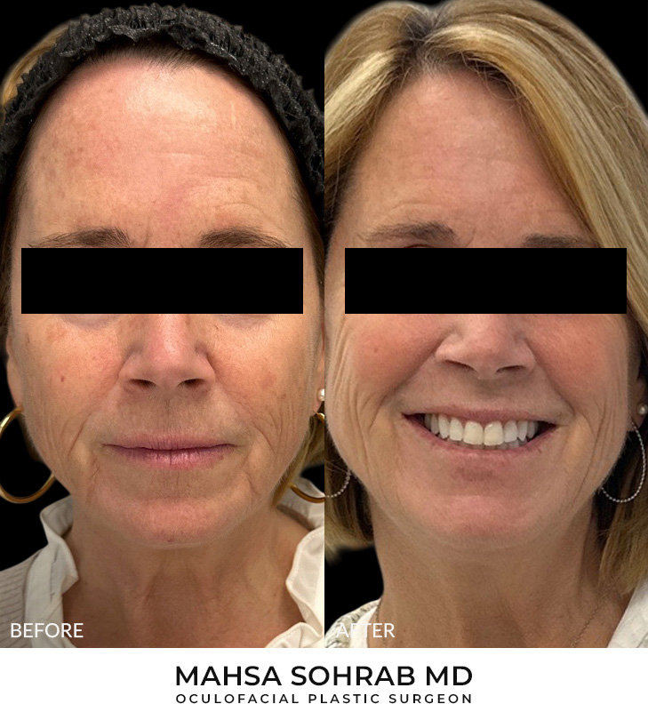 60 year old woman bothered by discoloration on the face. After photos obtained 3 months after a single BBL treatment.