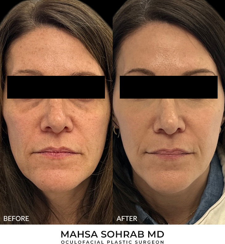 52 year old woman bothered by discoloration on face, chest, and shoulders. After photos obtained 1 month after a single BBL treatment.