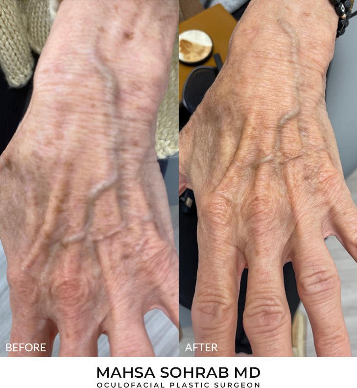 69 year old woman bothered by discoloration on the hands. After photos obtained 2 months after a single BBL treatment.