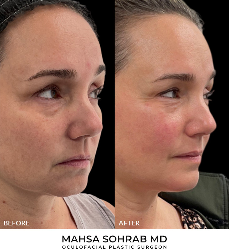 50 year old woman who was bothered by her mild double chin and jawline, underwent in-office FaceTite to improve jawline contour. After photos obtained 3 months post-procedure, results typically last 5-7 years.