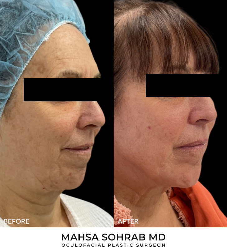 65 year old woman who was bothered by her jawline contour. She was not interested in pursuing a surgical lower facelift. Her after results 3 months post-FaceTite in the office reveal improved definition of the jawline. Results typically last 5-7 years.