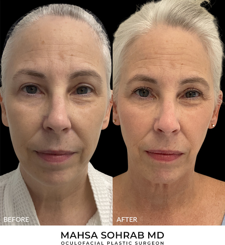 59 year old woman who was bothered by her jawline contour. She underwent radiofrequency-assisted liposuction with FaceTite for improvement of the submental region and jawline. After photos obtained 3 months post-procedure, results typically last 5-7 years.