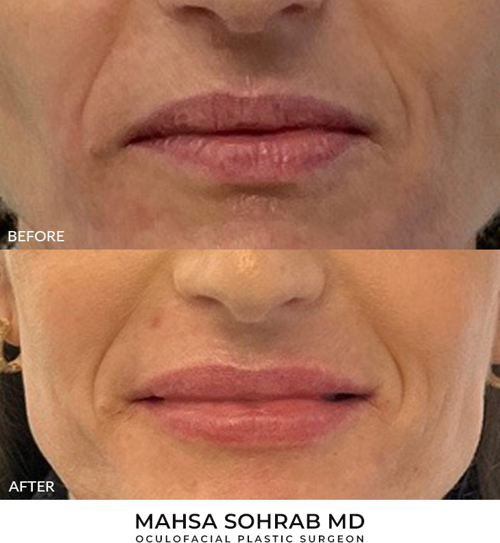 45 year old woman who was bothered by lip volume loss and asymmetry. She underwent upper blepharoplasty and lip filler placement for lip augmentation. After photos are immediately post-lip filler treatment.