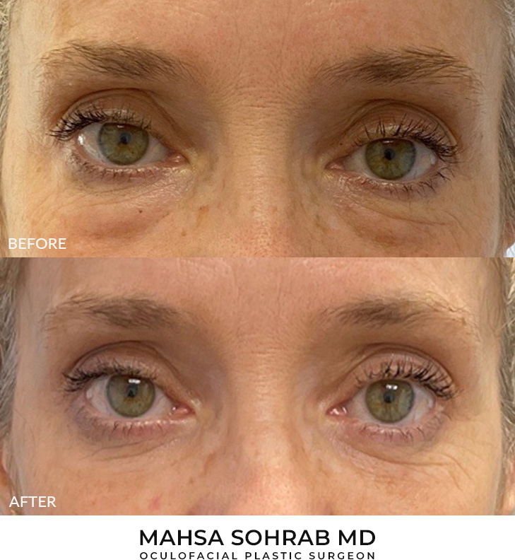 55 year old woman who was bothered by the appearance of her lower eyelids. She underwent transconjunctival lower eyelid blepharoplasty. After photos were obtained 3 months after surgery. Results can last 10 years.