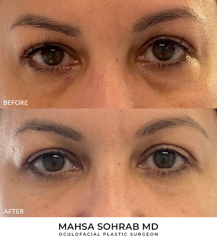 50 year old woman who was bothered by the appearance of her lower eyelids. She underwent transconjunctival lower eyelid blepharoplasty. After photos were obtained 4 months after surgery. Results can last 10 years.
