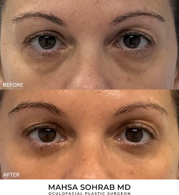 51 year old woman who was bothered by the appearance of her lower eyelids. She underwent transconjunctival lower eyelid blepharoplasty with fat transposition, skin pinch, and CO2 resurfacing. After photos were obtained 6 months post-procedure. Results can last 10 years.