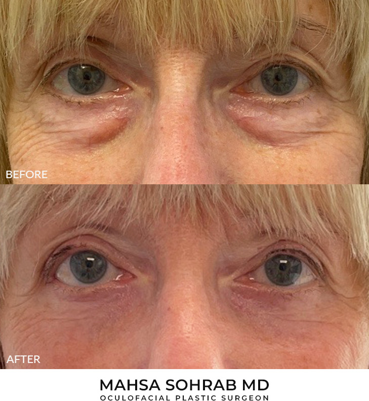 70 year old woman who was bothered by the appearance of her lower eyelids. She underwent transconjunctival lower eyelid blepharoplasty with fat transposition and skin pinch. After photos were obtained 6 months post-procedure.