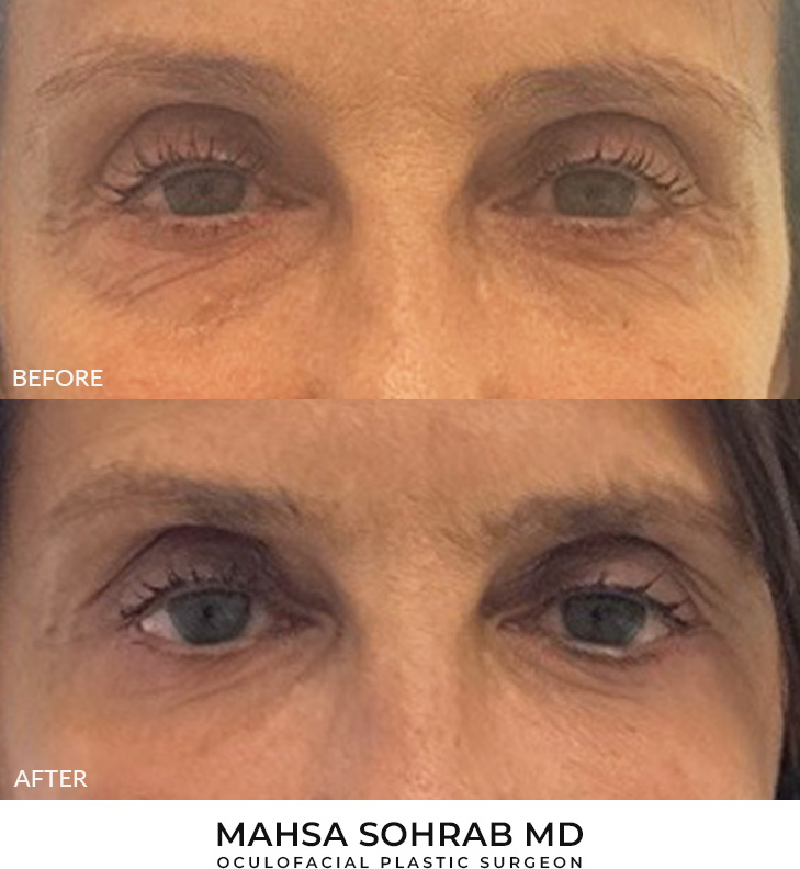 65 year old woman who was bothered by the appearance of her lower eyelids. She underwent lower eyelid blepharoplasty and CO2 resurfacing. After photos were obtained 3 months post-procedure.
