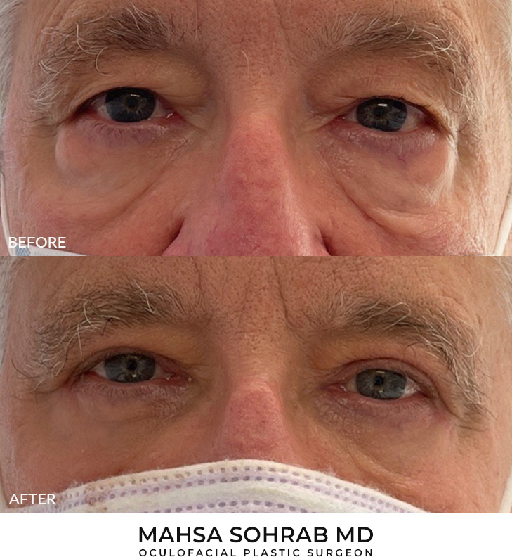 65 year old man who was bothered by the appearance of his upper and lower eyelids. He underwent upper and lower eyelid blepharoplasty with internal browpexy, mid-face SOOF lift, and CO2 resurfacing. After photos are 2 months post-procedure. Results typically last 7-10 years.