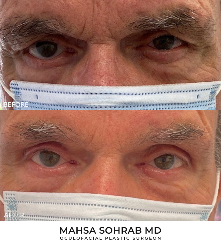 78 year old man who was bothered by the appearance of his upper eyelids. He underwent upper eyelid blepharoplasty. After photos were obtained 3 months post-procedure.