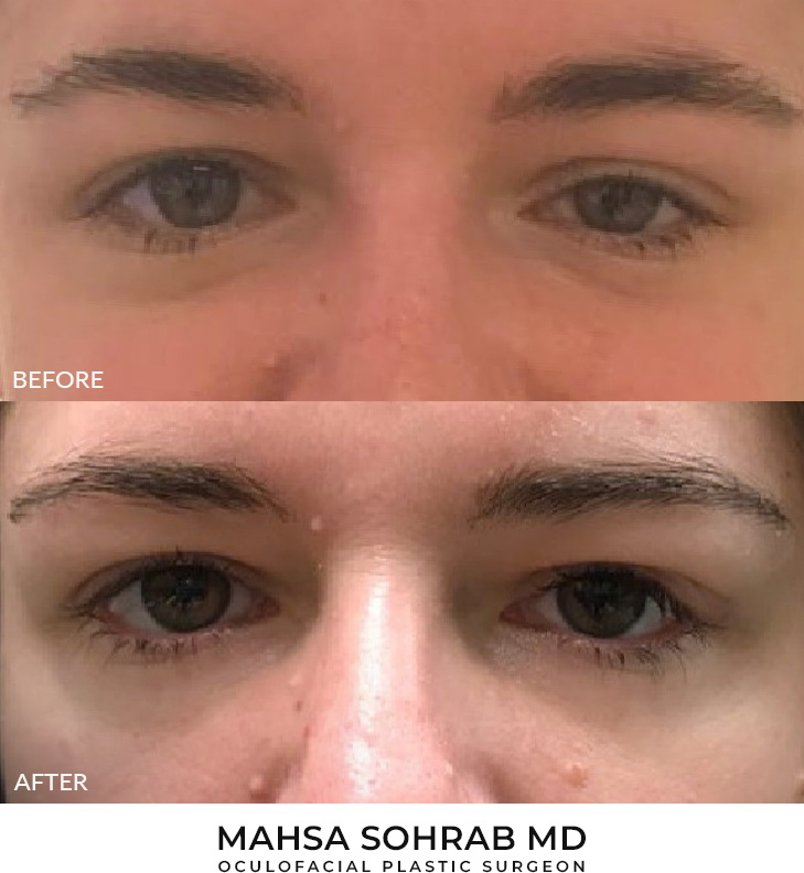 30 year old woman who was bothered by drooping of the left upper eyelid. She underwent external ptosis repair. After photos are 1 month post-left upper eyelid ptosis repair. Results can last 10 years.