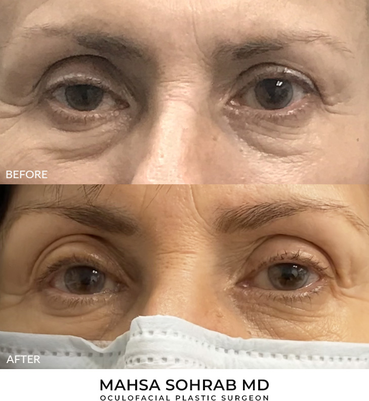 56 year old woman who was bothered by drooping of the right upper eyelid. She underwent external ptosis repair. After photos are 1 month post-right upper eyelid ptosis repair. Results can last 10 years.