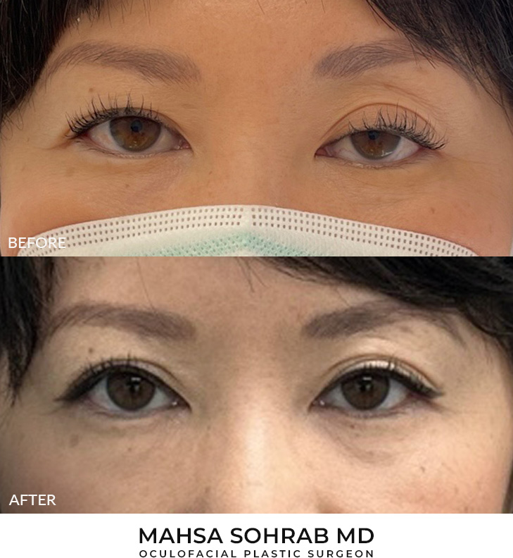 41 year old woman who was bothered by drooping of both upper eyelids. She underwent external ptosis repair. After photos are 2 months post-bilateral upper eyelid ptosis repair. Results can last 10 years.