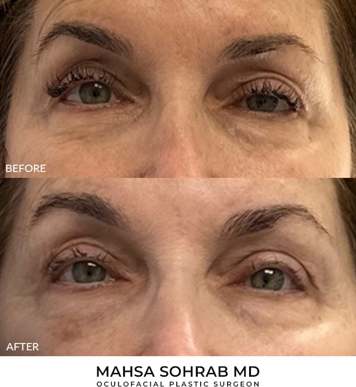 77 year old woman who was bothered by drooping of the upper eyelids. She underwent external ptosis repair. After photos are 3 months post-bilateral external ptosis repair. Results can last 10 years.