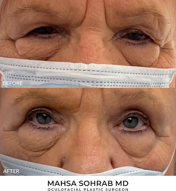 88 year old woman who was bothered by drooping of the upper eyelids. She underwent external ptosis repair and blepharoplasty of the upper eyelids. After photos are 1 month post-bilateral external ptosis repair and blepharoplasty. Results can last 10 years.