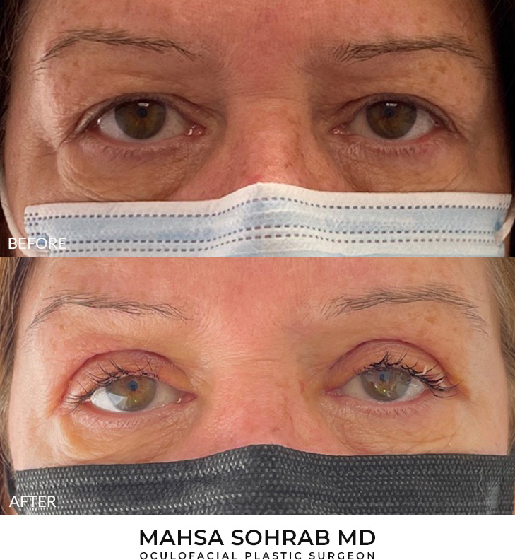64 year old woman who was bothered by her upper eyelid appearance. She underwent in-office upper eyelid blepharoplasty. After photos show results at 1 week post-surgery. Swelling will gradually resolve over the next several weeks.