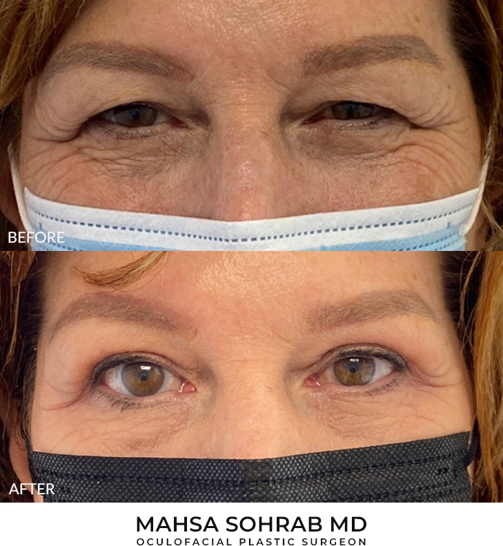 58 year old woman who was bothered by her upper eyelid appearance. She underwent in-office upper eyelid blepharoplasty and internal browpexy. After photos show results at 1 month post-surgery. Results can last 10 years.