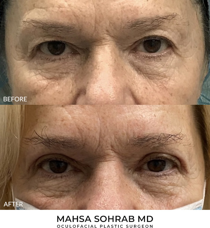62 year old woman who was bothered by her upper eyelid appearance. She underwent upper eyelid blepharoplasty. After photos show results at 3 months post-surgery.