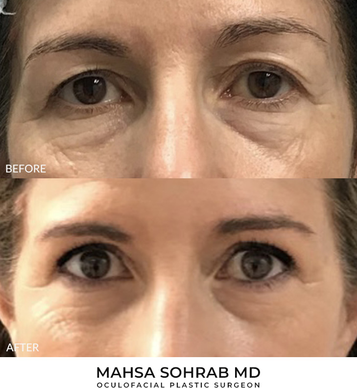 60 year old woman who was bothered by her upper eyelid appearance. She underwent upper eyelid blepharoplasty. After photos show results at 3 months post-surgery.