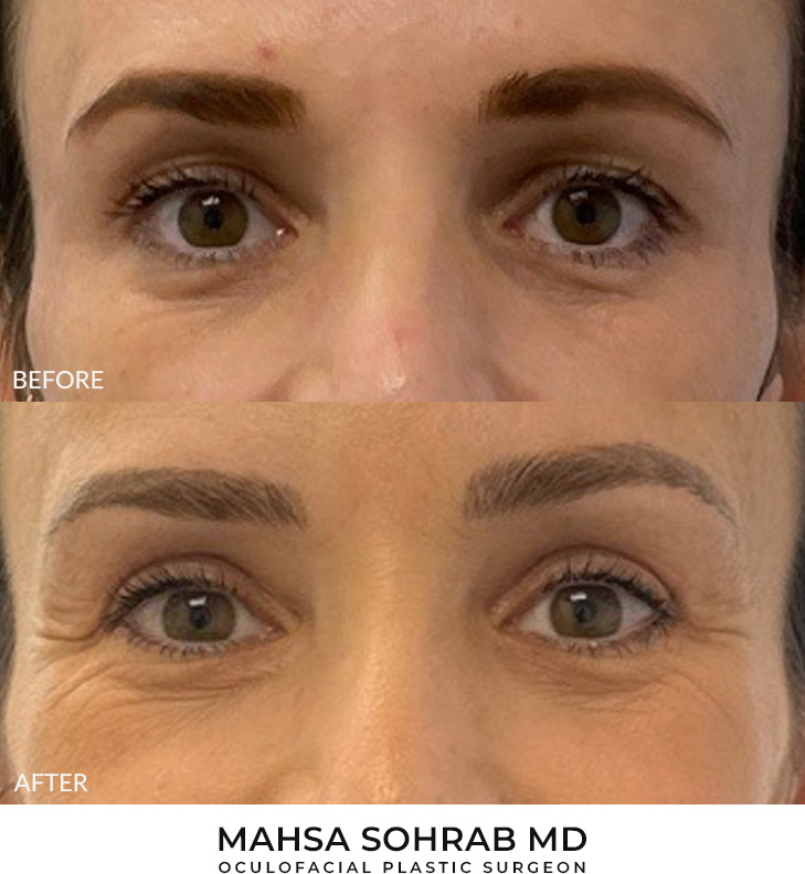 45 year old woman who was bothered by her upper eyelid appearance. She underwent upper blepharoplasty. After photos are 3 months post-surgery.
