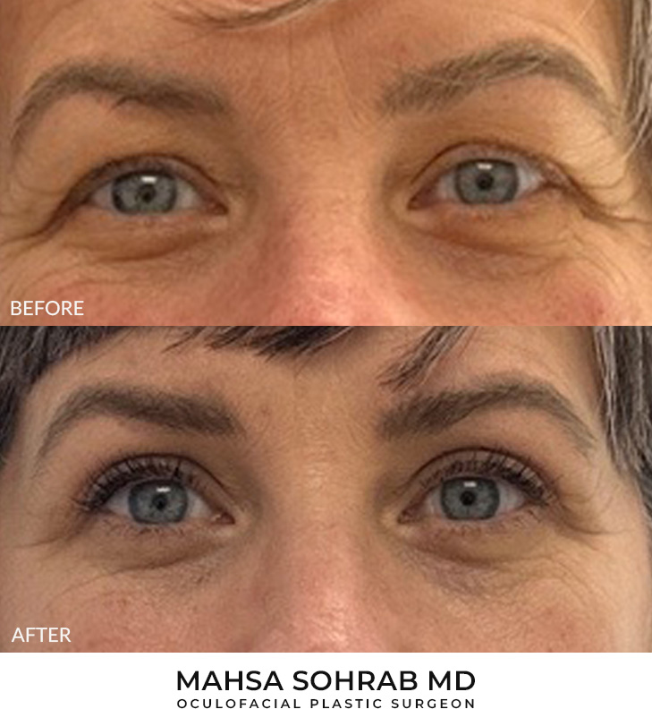 53 year old woman who was bothered by her upper eyelids appearance. She underwent upper blepharoplasty. After photos are 3 months post-surgery.