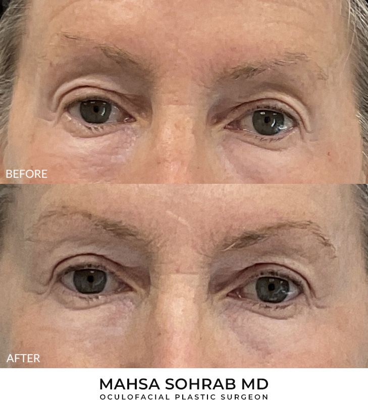 64 year old woman who was bothered by her upper eyelid appearance. She underwent upper eyelid blepharoplasty and Morpheus8 treatment. After photos show results at 1 month and 3 months post-surgery.