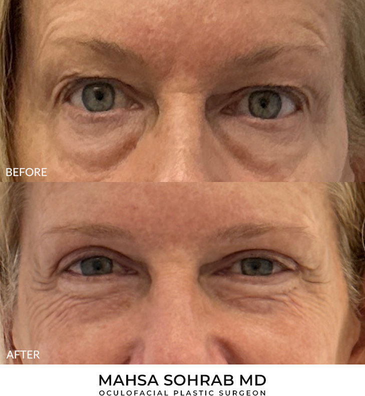 60 year old woman who was bothered by her upper eyelid appearance. She underwent upper eyelid blepharoplasty and internal browpexy. After photos show results at 3 months post-surgery.