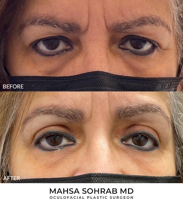 65 year old woman who was bothered by her upper eyelid appearance. She underwent upper eyelid blepharoplasty and internal browpexy. After photos show results at 3 months post-surgery.