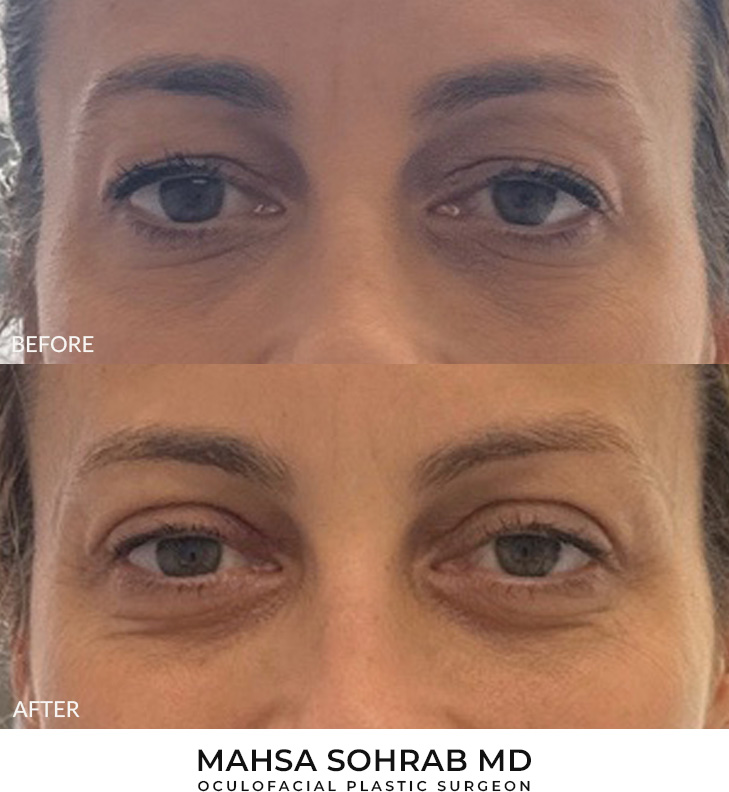 48 year old woman who was bothered by her upper eyelid appearance. She underwent upper eyelid blepharoplasty. After photos show results at 1 week and 3 months post-surgery.