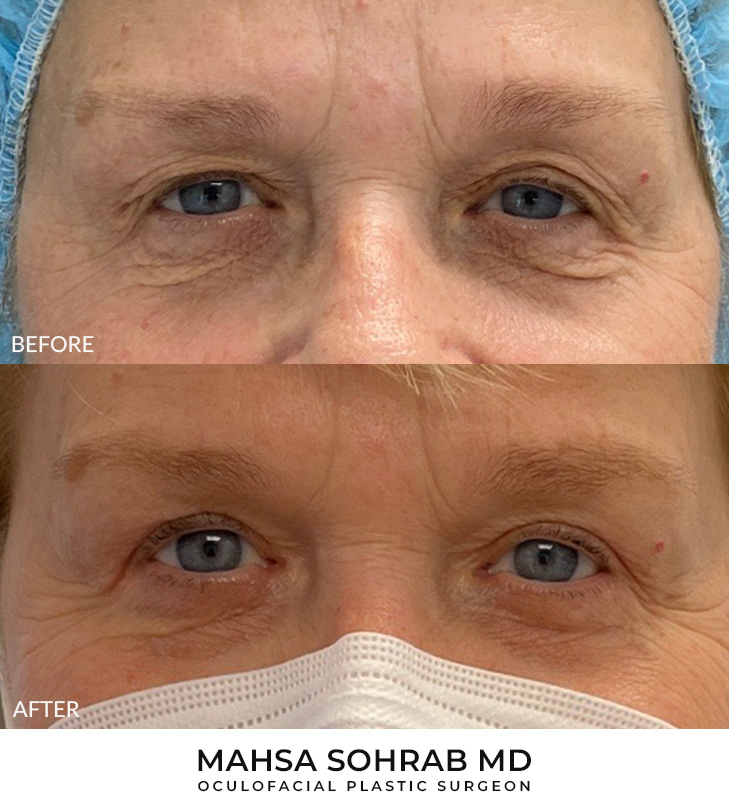 64 year old woman who was bothered by upper eyelid appearance. She underwent upper eyelid blepharoplasty with lower eyelid skin pinch blepharoplasty in-office under local anesthesia. After photos obtained 6 months post-surgery. Results can last 10 years.