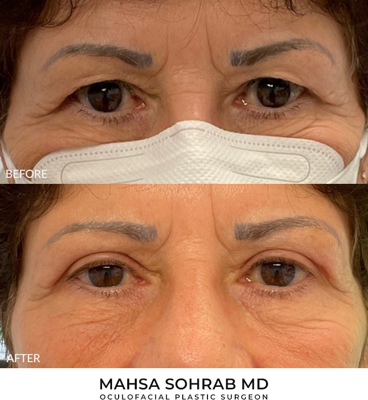 70 year old woman who was bothered by her upper eyelid appearance. She underwent upper eyelid blepharoplasty and internal browpexy. After photos are from 2 months post-surgery. Results can last 10 years.