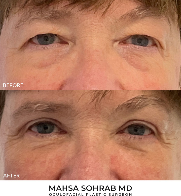 60 year old woman who was bothered by her upper and lower eyelid appearance. She underwent upper and lower eyelid blepharoplasty. After photos are shown at 3 months post-surgery.
