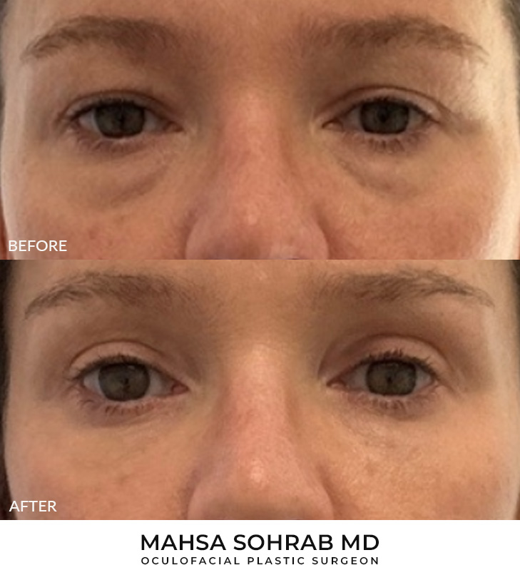 43 year old woman who was bothered by her upper and lower eyelid appearance. She underwent upper and lower eyelid blepharoplasty with periocular CO2. After results are shown at 3 months post-surgery.