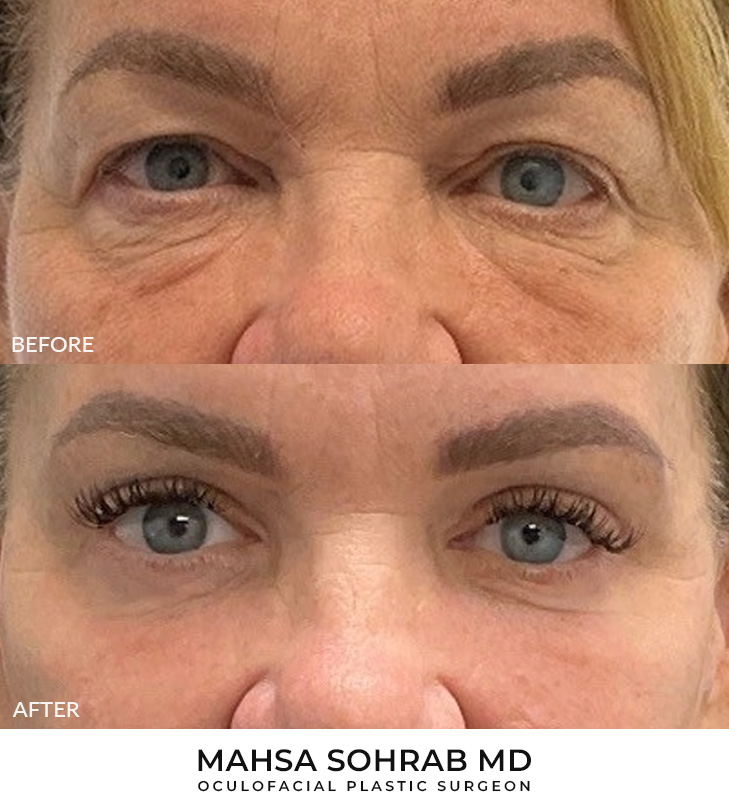 Upper & Lower Blepharoplasty Before and After Image