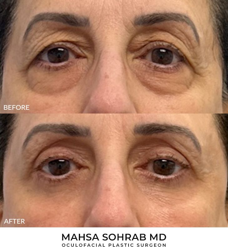 Upper & Lower Blepharoplasty Before and After Image