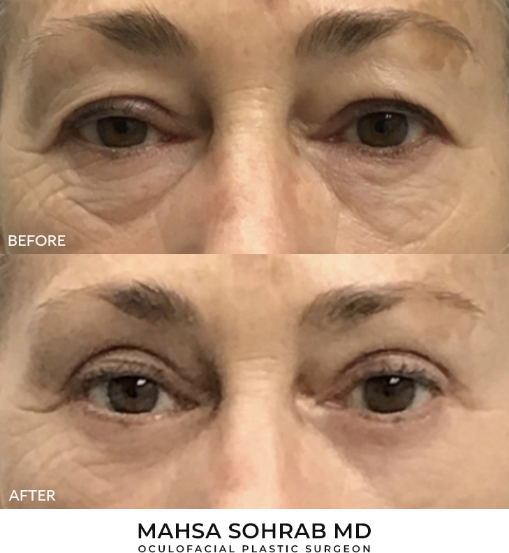 50 year old woman who was bothered by her upper and lower eyelid appearance. She underwent upper and lower eyelid blepharoplasty. After photos are 3 months post-surgery. Results can last 10 years.