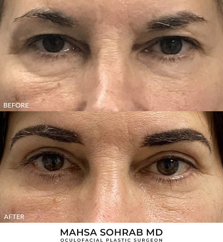 50 year old woman who was bothered by her upper and lower eyelid appearance. She underwent upper and lower eyelid blepharoplasty. After photos are 3 months post-surgery. Results can last 10 years.