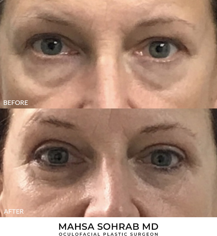 52 year old woman who was bothered by her upper and lower eyelid appearance. She underwent upper and lower eyelid blepharoplasty with mini cheek lift. After photos are 3 months post-surgery. Results can last 10 years.