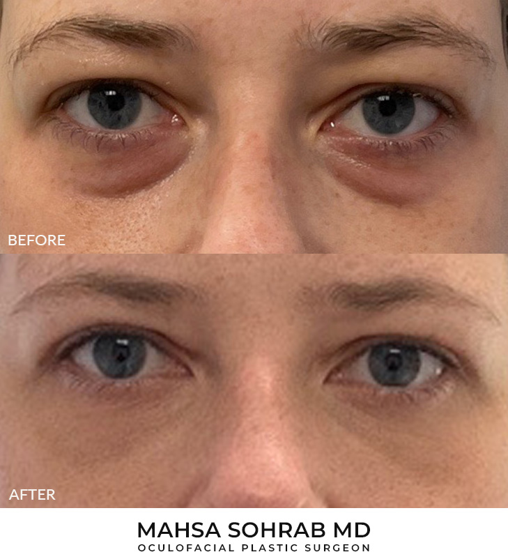 30 year old woman who was bothered by her upper and lower eyelid appearance. She underwent upper and lower eyelid blepharoplasty with fat grafting and CO2 resurfacing of the skin. After photos are shown at 1 month and 3 months post-surgery. Results can last 10 years.