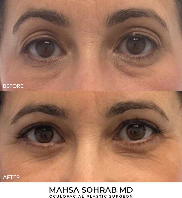 48 year old woman who was bothered by her upper and lower eyelid appearance. She underwent upper and lower eyelid blepharoplasty with fat transposition and skin pinch. After photos are shown at 3 months post-surgery. Results can last 10 years.