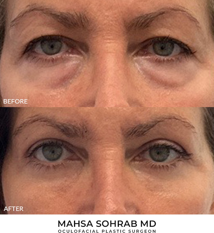 56 year old woman who was bothered by her upper and lower eyelid appearance. She underwent upper and lower eyelid blepharoplasty with fat transposition, periocular CO2 resurfacing, and Morpheus8 treatment. After photos are shown at 3 months post-surgery.