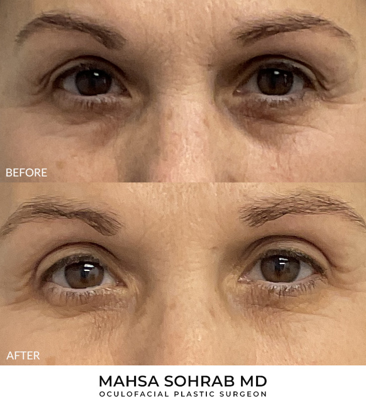 Upper Blepharoplasty Patient 33