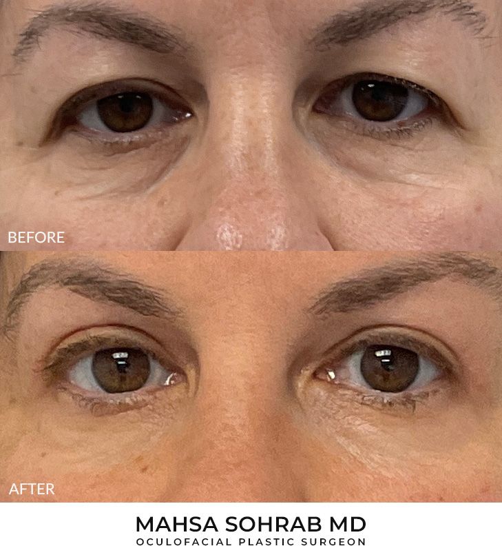 Upper Blepharoplasty Patient 34