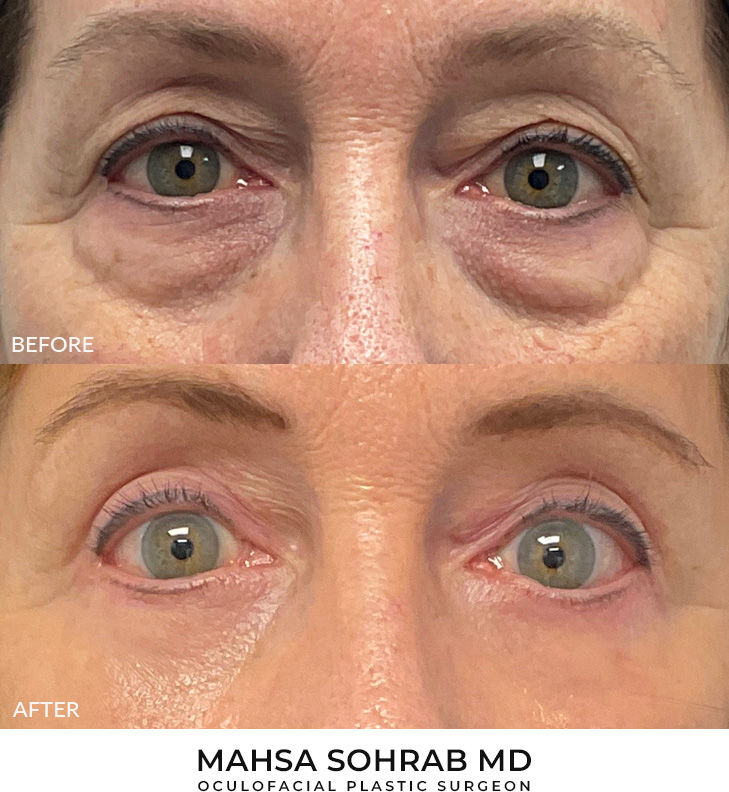 upper and lower blepharoplasty patient 14
