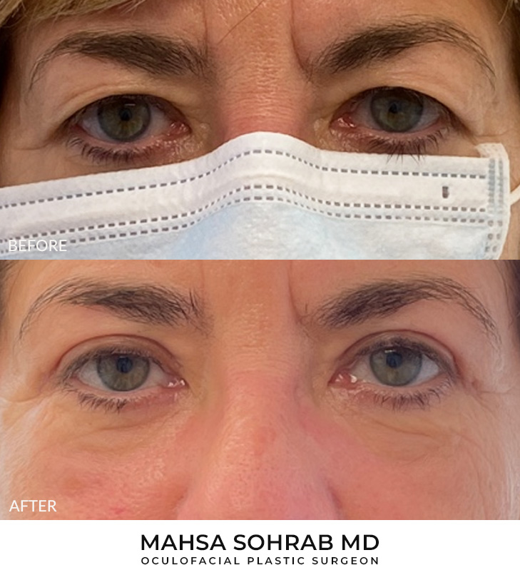 Upper Blepharoplasty Patient 30