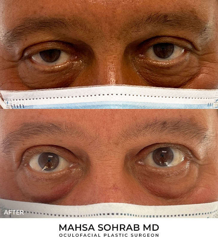 Ptosis Repair Patient 10