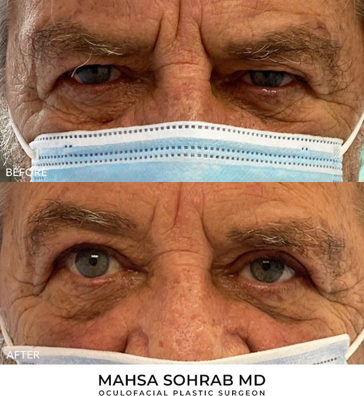 Male Blepharoplasty Patient 06