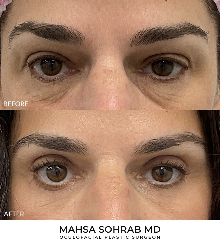 Upper & Lower Blepharoplasty Patient 15