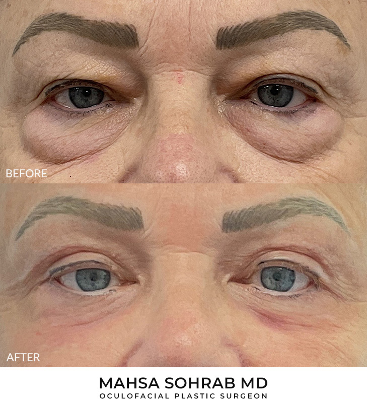 Upper & Lower Blepharoplasty Patient 16