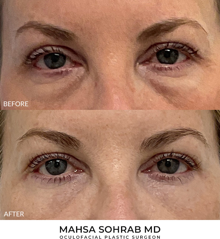 Upper & Lower Blepharoplasty Patient 17